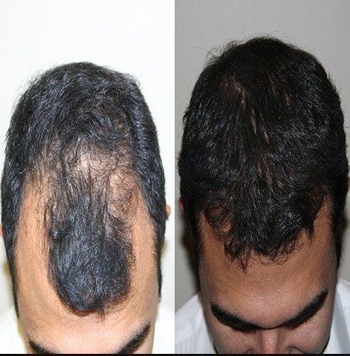 Intervention Step in Hair Transplant