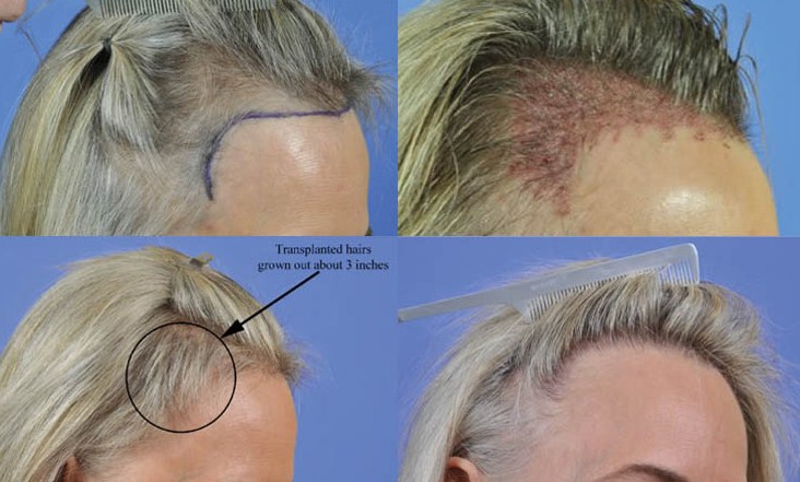 Hair Implantation