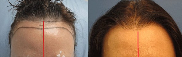 Hair Implantation In Women Before After