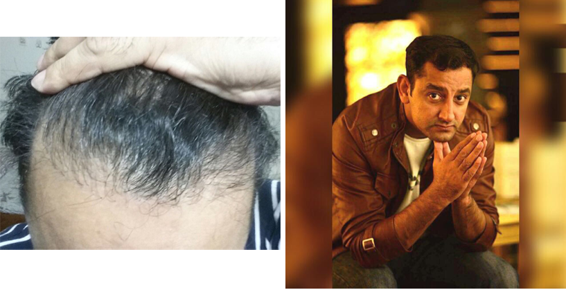 Before & After - HairnHair