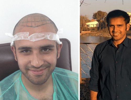 Best hair transplants: interesting results